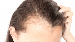 Выпадение волос у женщин - причины, симптомы, лечение и профилактика